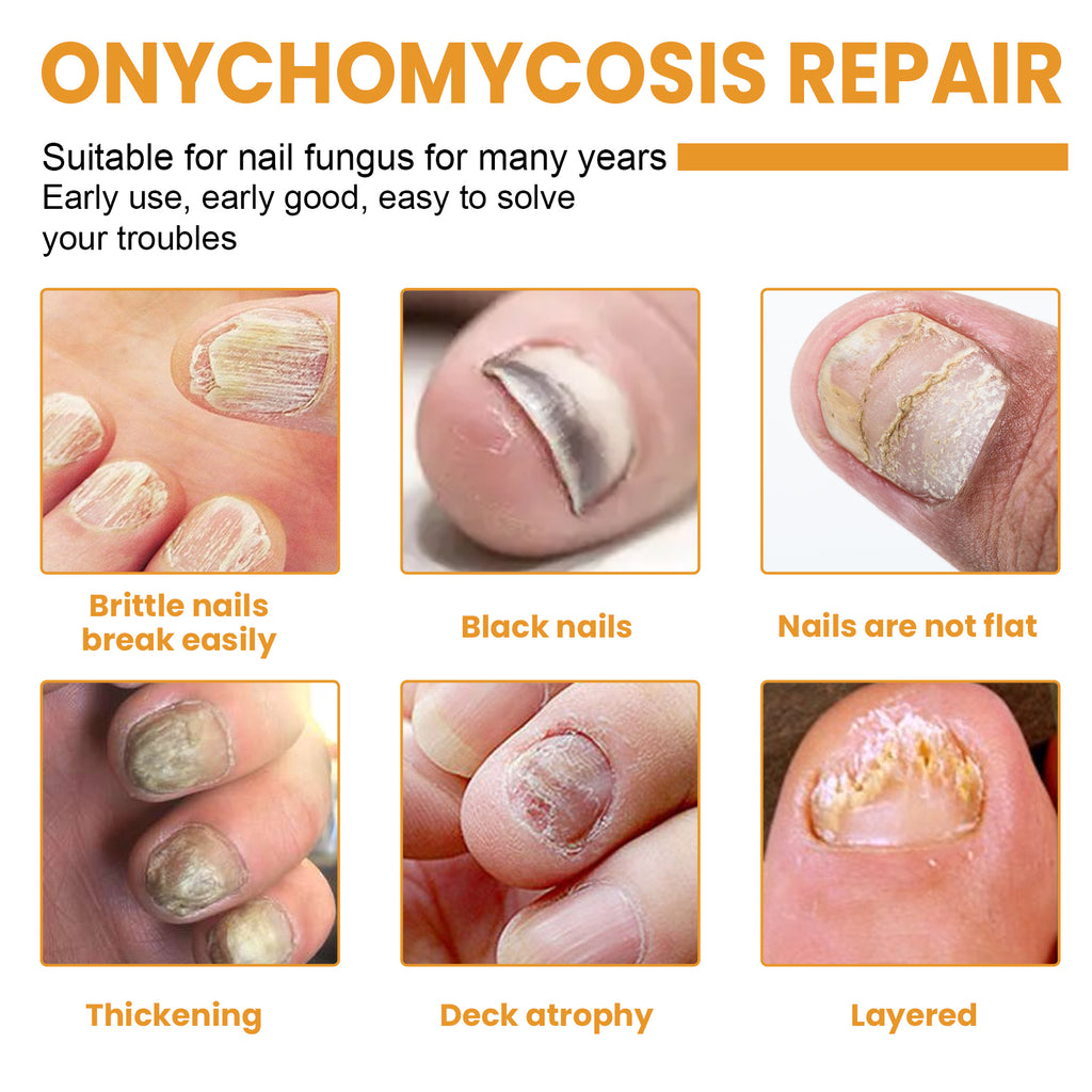 Fungal Nail Patches, Repair Nail Thickening Grey Nail Soft Nail Shine Nail Care Patch